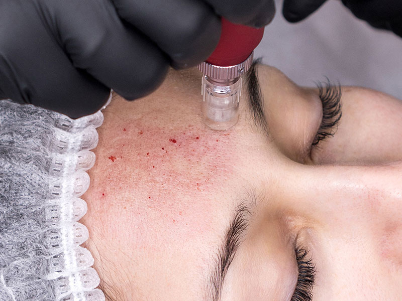 Get PRP Facial Treatment >